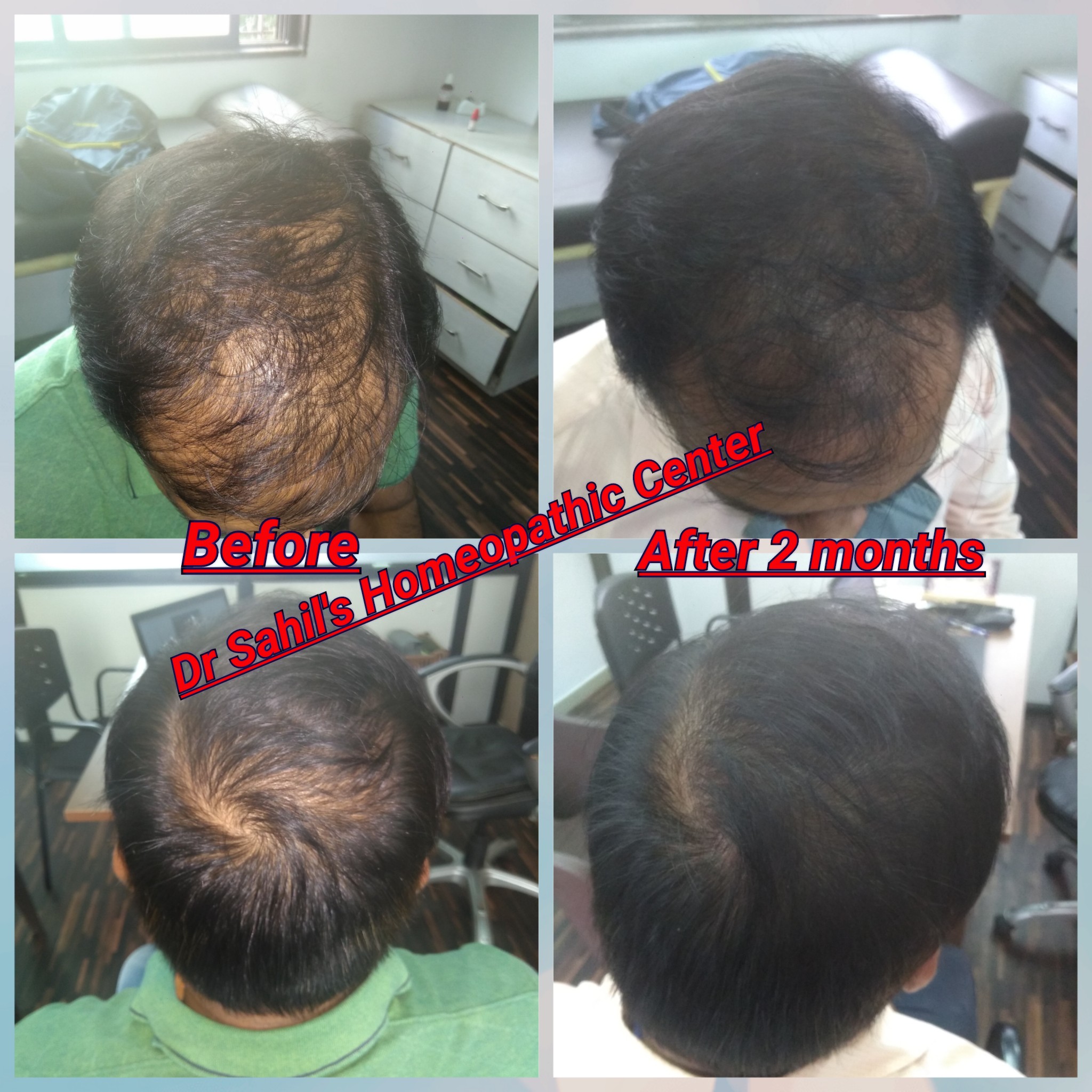 Alopecia Areta