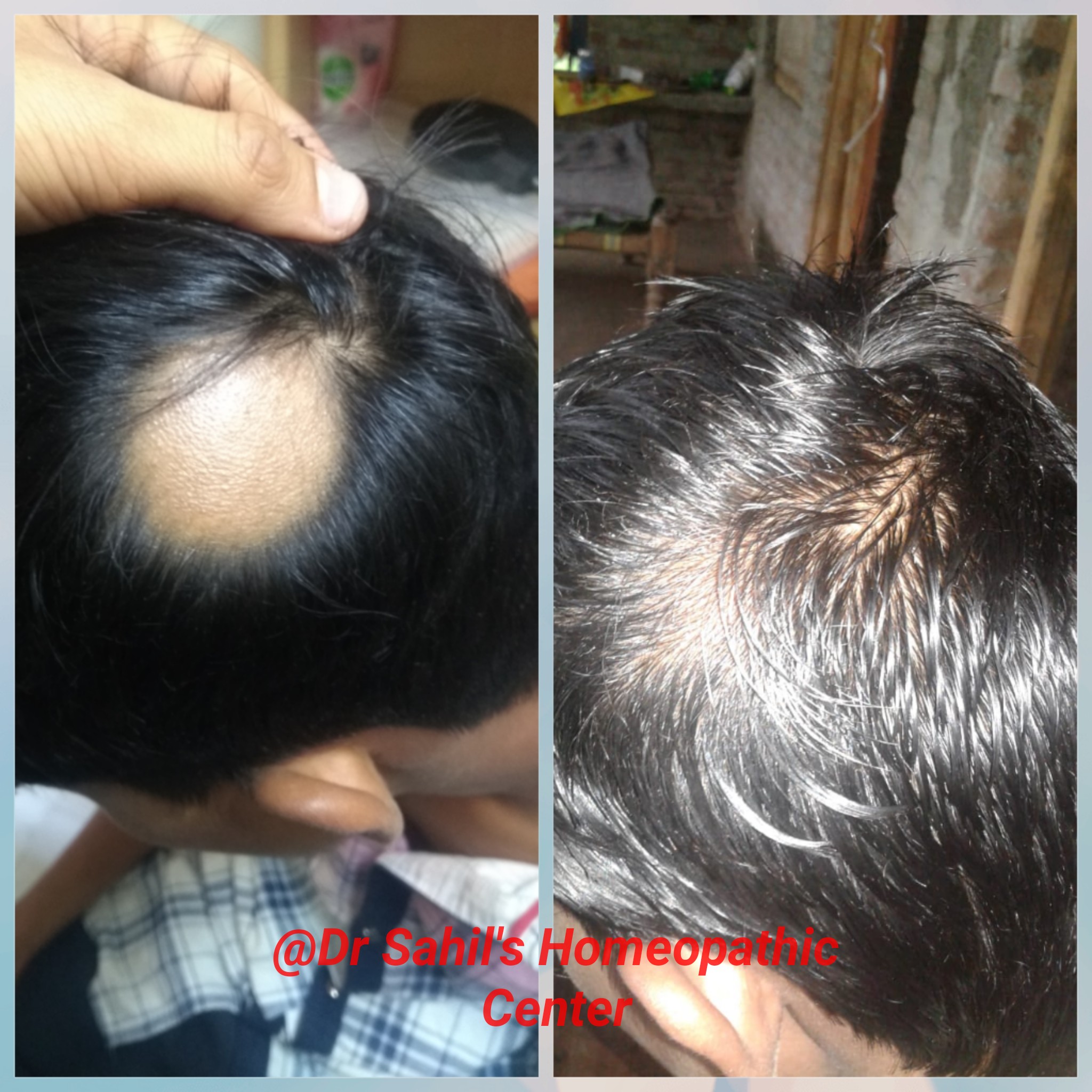 Alopecia Areta