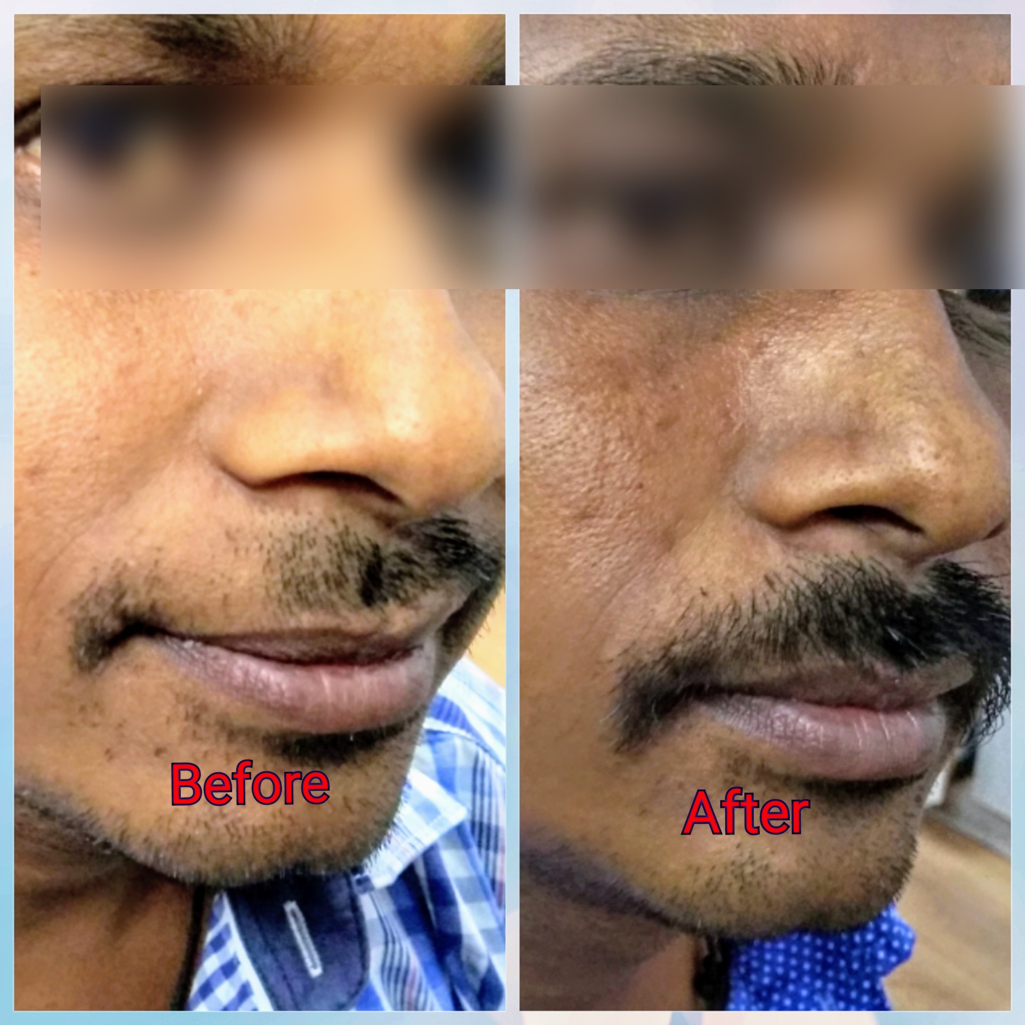 Alopecia Areta